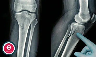 Nga sot protestuesit mund të porositin thyerjen e kockave në e-Albania